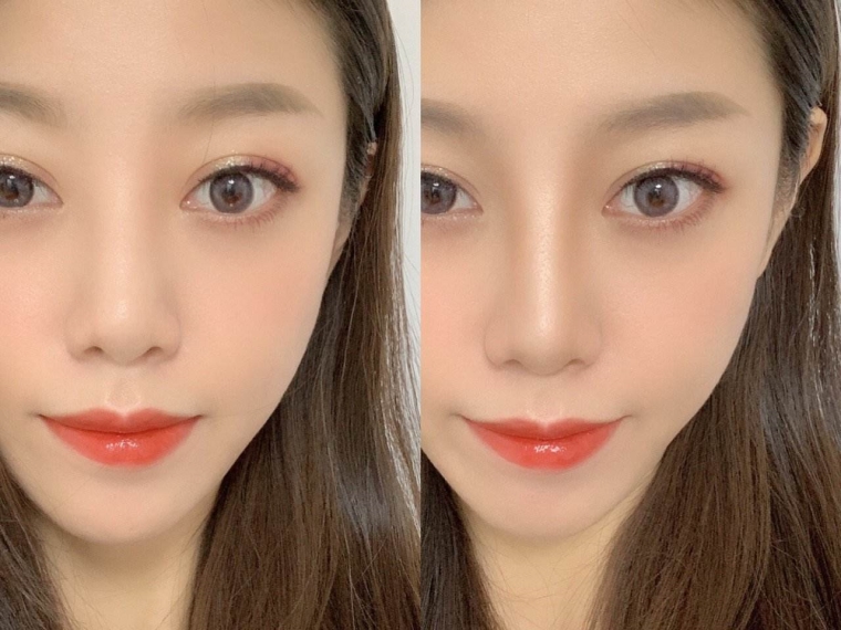 假体隆鼻价格一般多少?