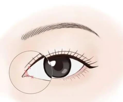 开眼角.jpg