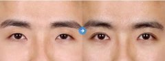 男士割双眼皮的方法有哪些