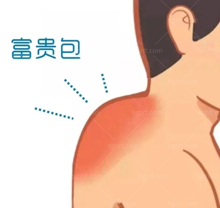 国内治疗富贵包的专科医院哪个好 国内治疗富贵包的专科医院哪个好