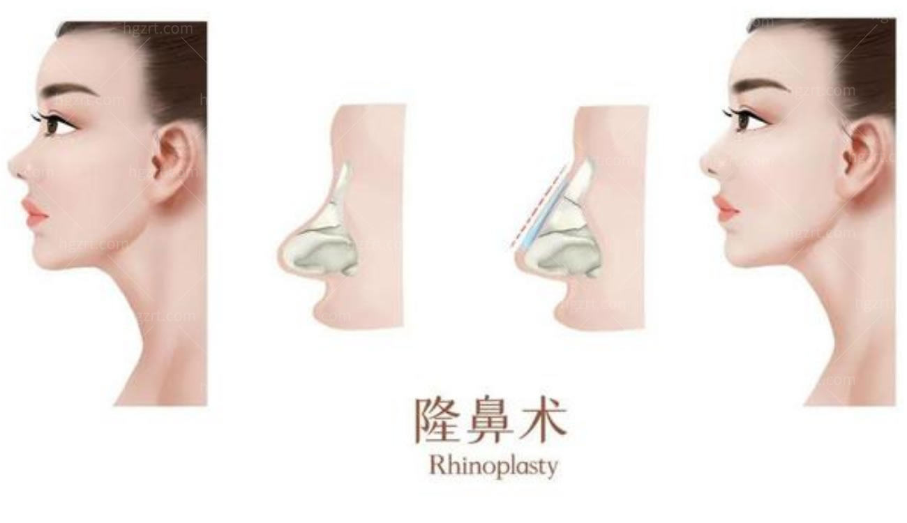 鼻修复.jpg 鼻修复.jpg