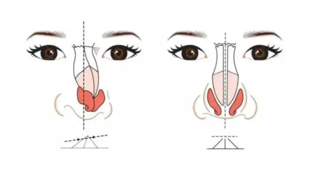 鼻修复.jpg 鼻修复.jpg