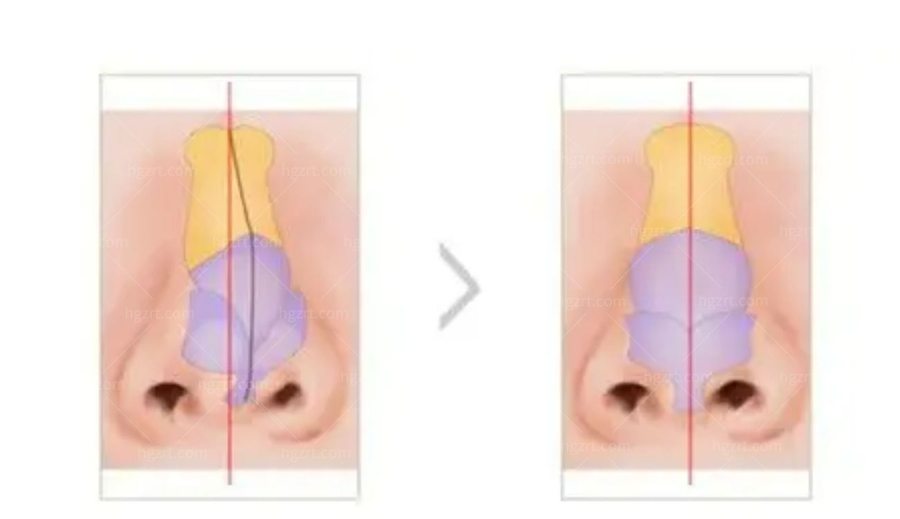鼻修复手术会遇到的常见问题.jpg 鼻修复手术会遇到的常见问题.jpg