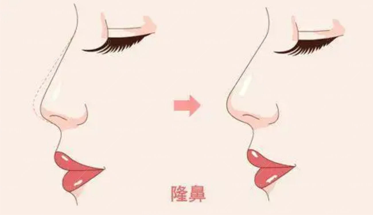 鼻修复手术会遇到的常见问题.jpg 鼻修复手术会遇到的常见问题.jpg