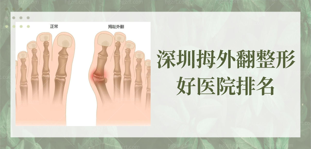 深圳拇外翻整形好医院排名 深圳拇外翻整形好医院排名