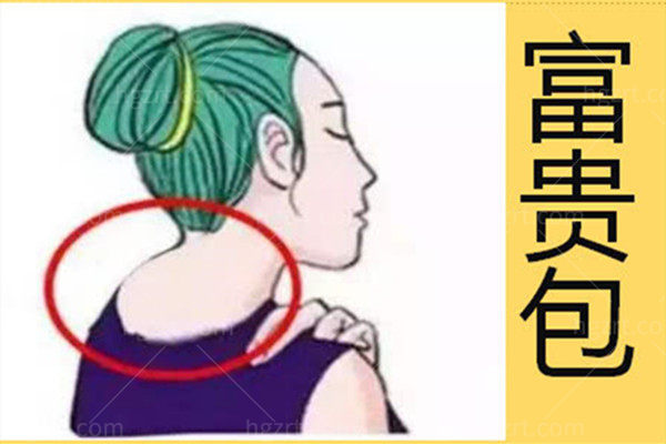 南京富贵包手术哪家医院做的好 南京富贵包手术哪家医院做的好