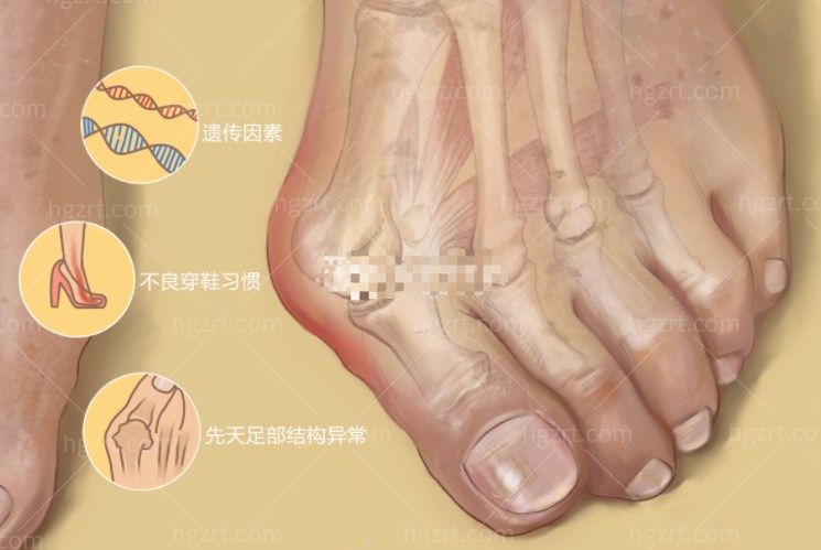 为什么会出现大脚趾拇外翻 为什么会出现大脚趾拇外翻