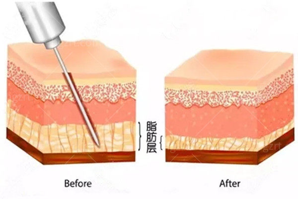 吸脂手术 吸脂手术