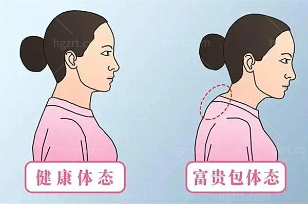 重庆富贵包去除 重庆富贵包去除