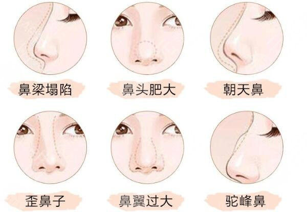 需要整形的鼻部问题 需要整形的鼻部问题