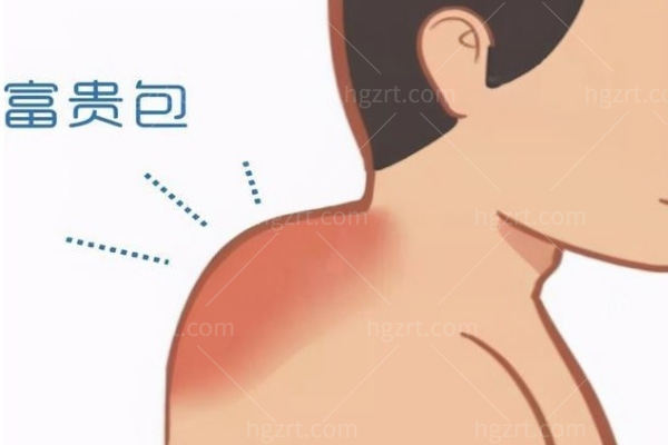 如何去除富贵包 如何去除富贵包