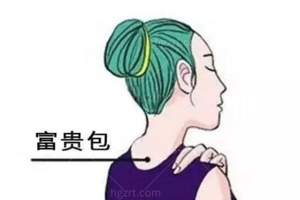 富贵包手术需要住院吗 富贵包手术需要住院吗