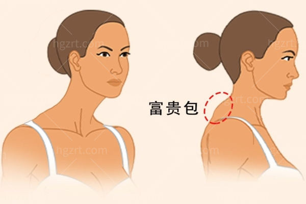 59岁可以做富贵包吗 59岁可以做富贵包吗