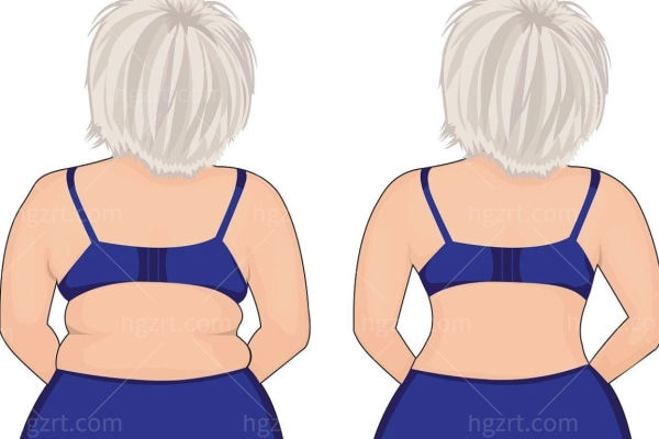 背部吸脂多少钱 背部吸脂多少钱