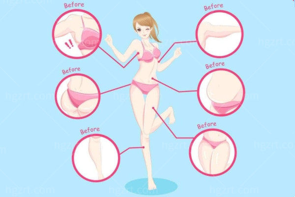 吸脂减肥会不会出现反弹?很想吸脂又怕对身体有副作用 吸脂减肥会不会出现反弹?很想吸脂又怕对身体有副作用