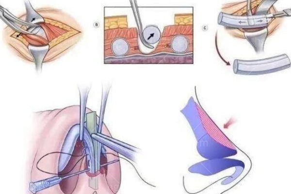 我的肋软骨隆鼻日记分享,虽然很遭罪但是终于摆脱了我的大蒜鼻 我的肋软骨隆鼻日记分享,虽然很遭罪但是终于摆脱了我的大蒜鼻