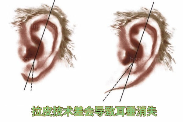 技术好的拉皮手术医生优势 技术好的拉皮手术医生优势