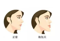 正颌手术可以改善脸型吗? 正颌手术可以改善脸型吗?