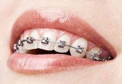 牙齿整形的标准是什么呢?