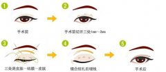 韩式三点双眼皮有什么特色呢