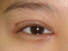关于双眼皮手术后的修复方法