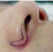 能做手术缩小肥大的鼻头吗