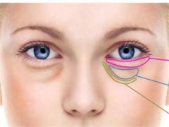 祛黑眼圈的小妙招