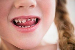 牙齿畸形原因有哪些？什么样的牙齿畸形需要纠正？