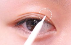 什么原因会导致双眼皮修复手术的失败呢