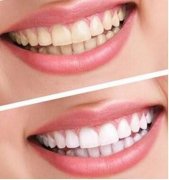 美白牙齿的妙招有哪些