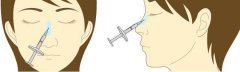 微创隆鼻的手术过程是怎样的呢