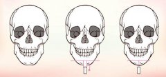 下颌角整形手术要如何选择手术切口呢
