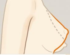 乳房下垂矫正手术会留下疤痕吗