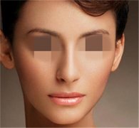 假体垫鼻子鼻整形手术专家讲解假体垫鼻让你的脸部