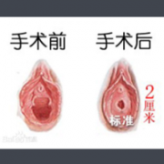 产后阴道松弛多久可以做阴道紧缩手术