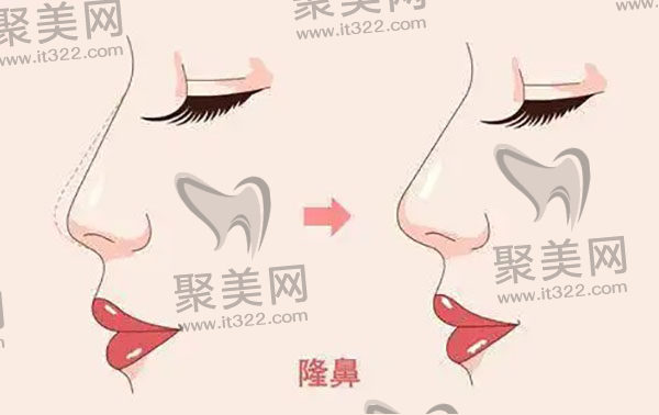 隆鼻假体可以不取出来吗? 隆鼻假体可以不取出来吗?