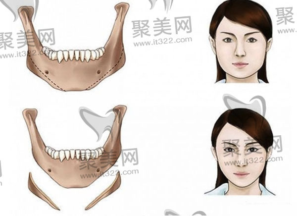 做完下颌角手术就后悔 做完下颌角手术就后悔