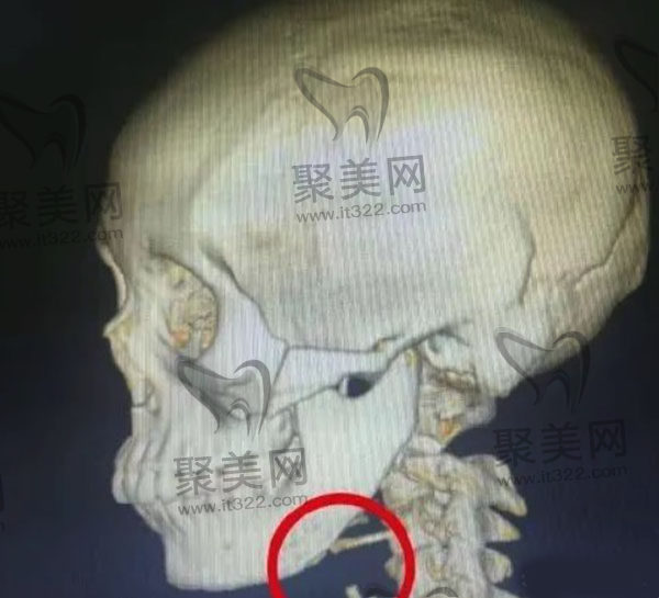 做完下颌角手术感觉没变化 做完下颌角手术感觉没变化