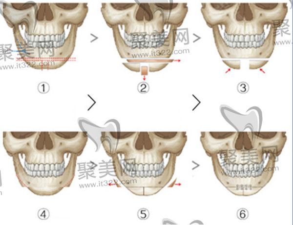 北京圣嘉新下颌角截骨手术过程 北京圣嘉新下颌角截骨手术过程