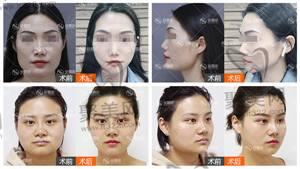 北京圣嘉新下颌角手术病例参考 北京圣嘉新下颌角手术病例参考