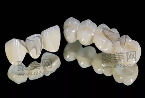烤瓷牙 烤瓷牙