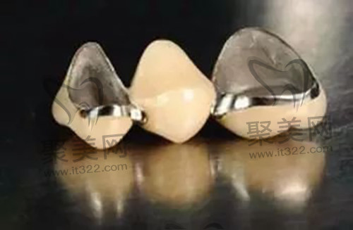 烤瓷牙 烤瓷牙
