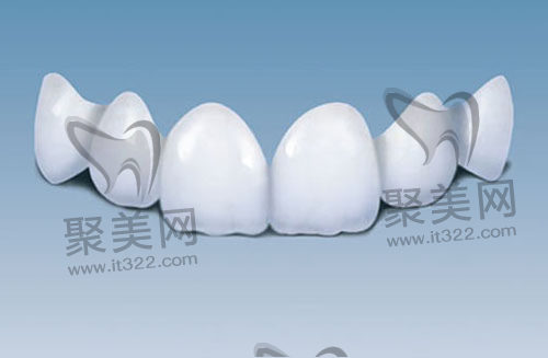 牙贴面 牙贴面