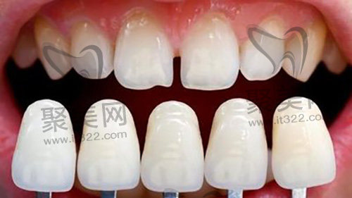 牙贴面比色 牙贴面比色