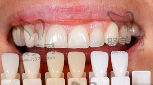 牙贴面 牙贴面