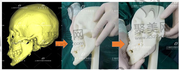 上海时光何晋龙下颌角截骨修复 上海时光何晋龙下颌角截骨修复