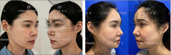 下颌角手术失败造成马脸畸形何晋龙修复病例 下颌角手术失败造成马脸畸形何晋龙修复病例