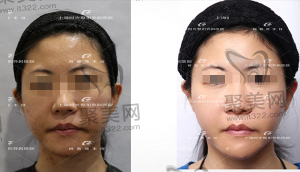 颧骨颧弓骨缺失PEEK修复恢复颧骨的饱满度病例 颧骨颧弓骨缺失PEEK修复恢复颧骨的饱满度病例