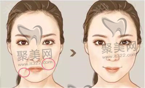 苹果肌填充 苹果肌填充