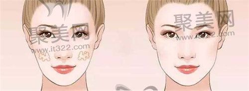 苹果肌填充 苹果肌填充